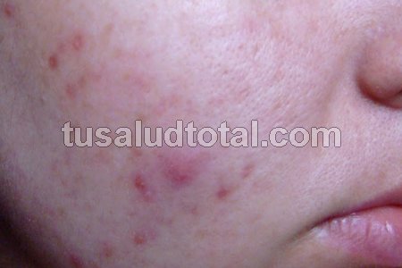Tratamiento para las manchas de acné rojas y moradas