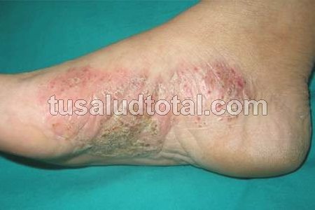 Un foto de la psoriasis palmoplantar y sus síntomas