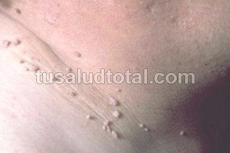 Las verrugas del cuello, axilas y tórax