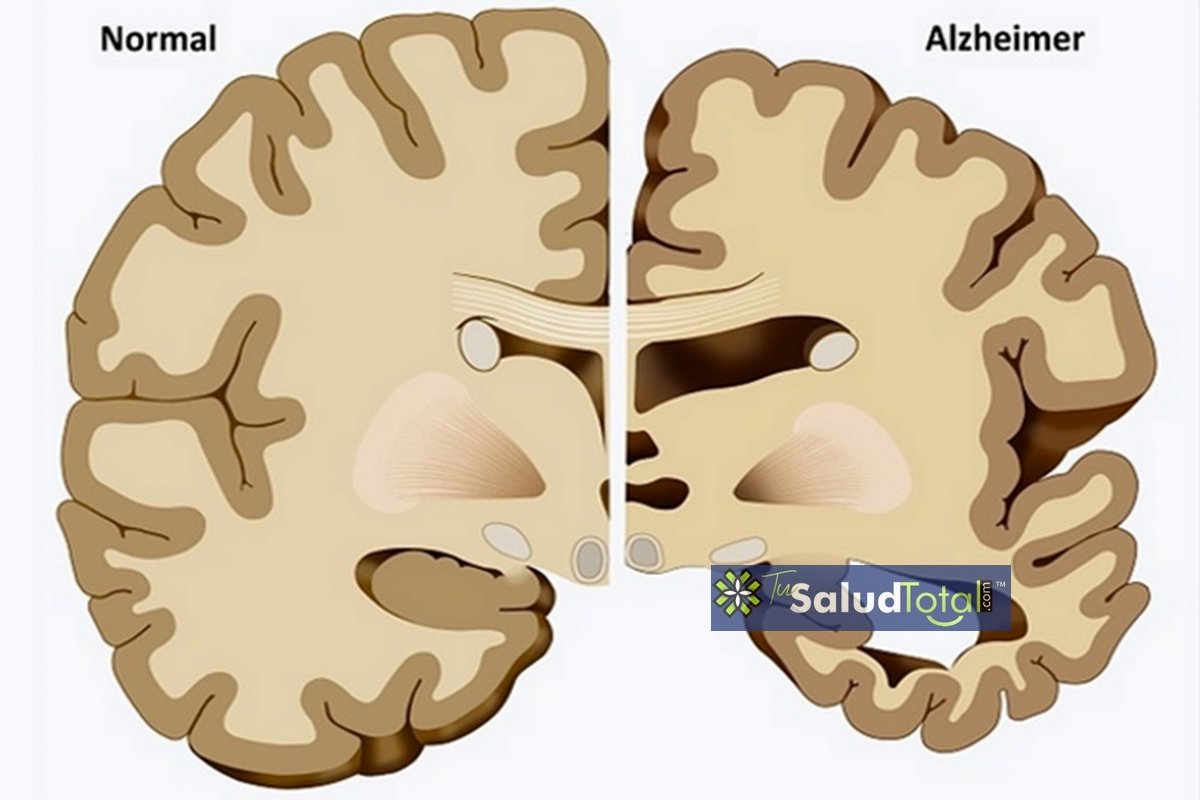 Ve aquí las fases del Alzheimer