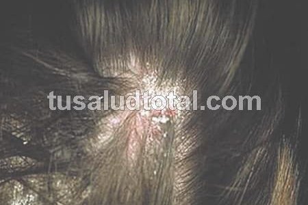 Síntomas de psoriasis en la cabeza