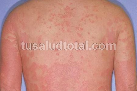 Imagen de psoriasis eritrodérmica en espalda