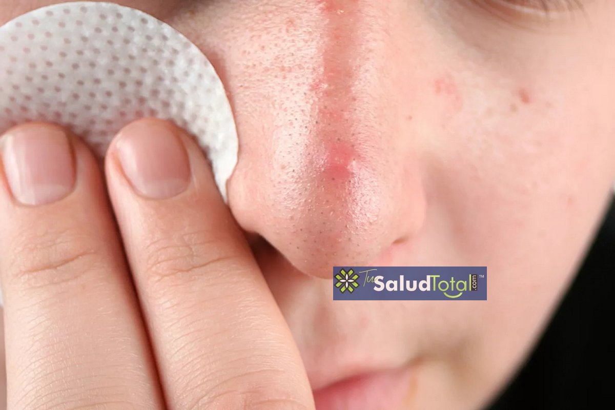 Cómo eliminar las espinillas de la nariz: exfoliación facial casera