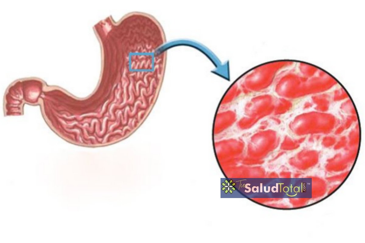 Ve aquí cómo es y en qué consiste la gastritis