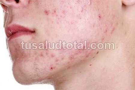 Cómo es el tratamiento para el acné juvenil