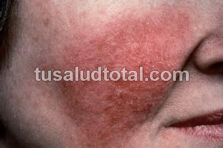 Uno de los síntomas de la rosácea: enrojecimiento de la cara