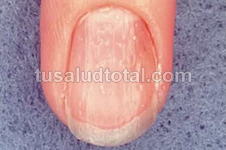 Signos de psoriasis en la uñas