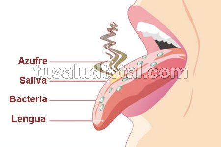 Qué es halitosis oral