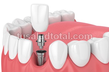 Ve cómo es un implante dental unitario