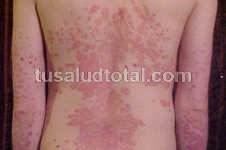 Psoriasis eritrodérmica síntomas en la espalda
