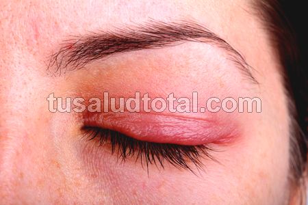 Cuáles son los síntomas de la rosácea ocular