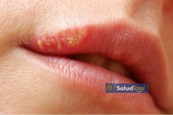 Descubre las causas del herpes labial