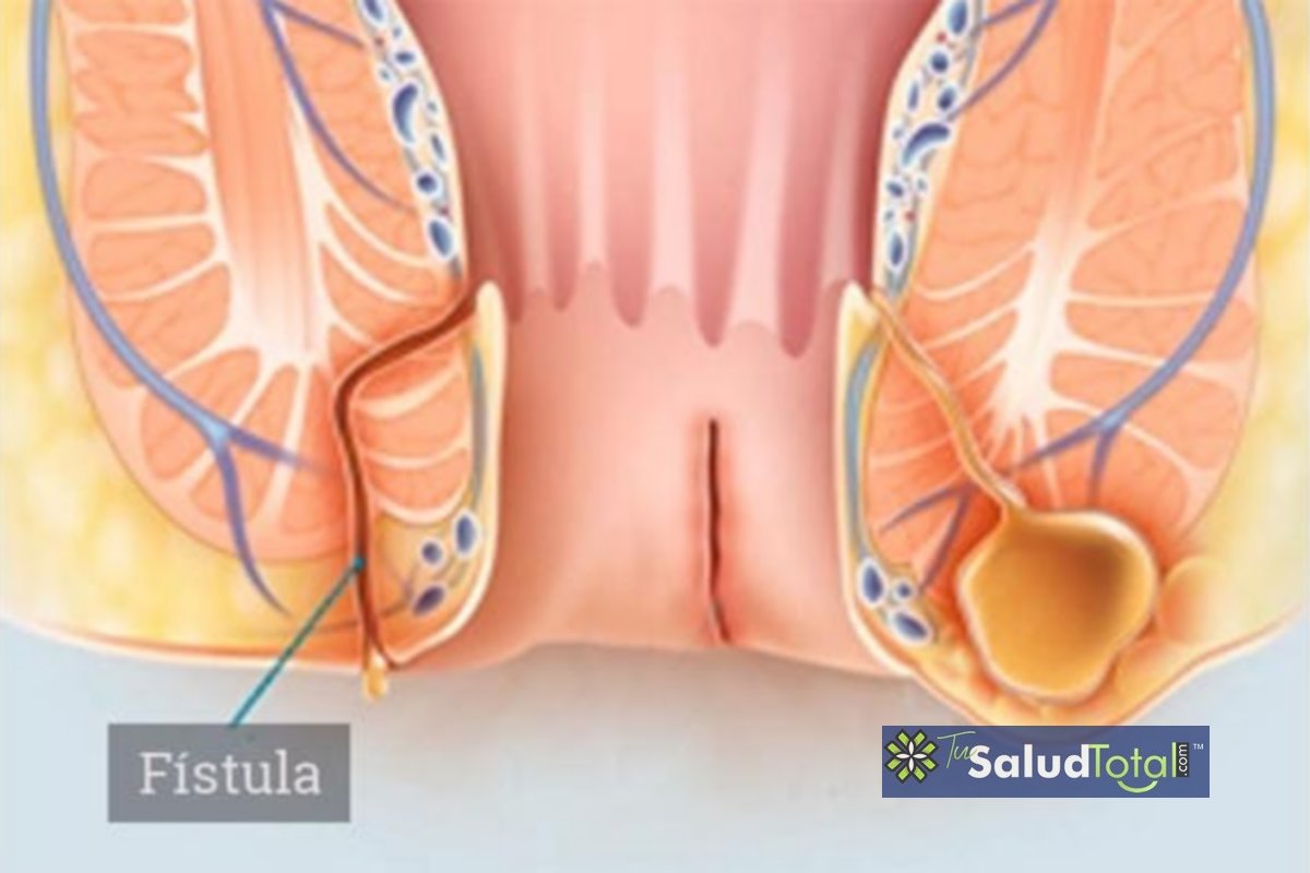 Fístula anorrectal: uma de las complicaciones de las hemorroides