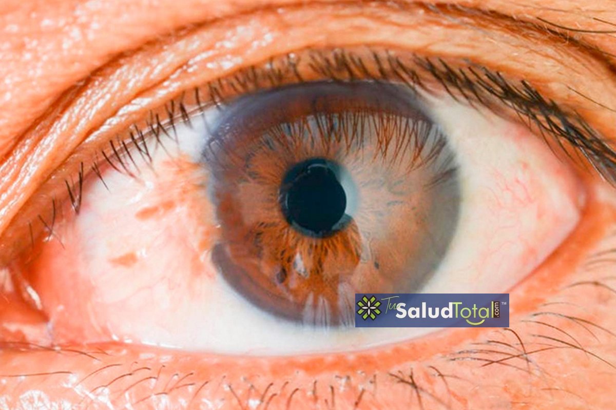 El pterigión es una de las condiciones más comunes en la zona ocular