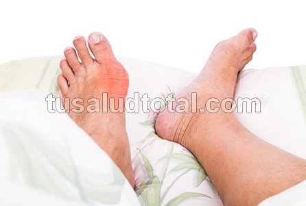 Dedo gordo del pie inflamado (qué es la enfermedad de la gota)
