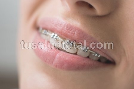 Qué es ortodoncia (brackets metálicos)