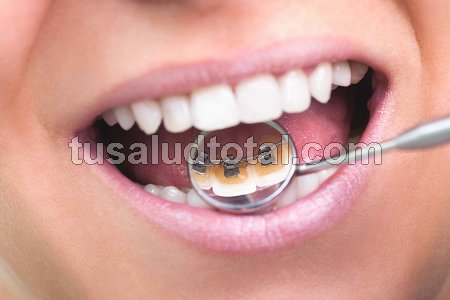 Tipos de ortodoncia (lingual)