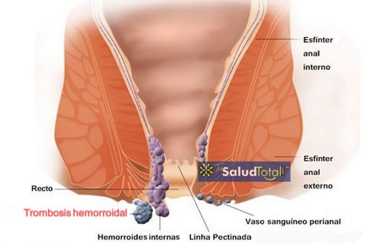 Cómo es una trombosis hemorroidal